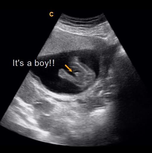 Ultrasound at 13 weeks gender
