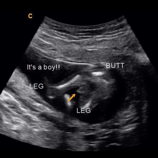 Can You Tell Gender At 14 Weeks 3 Days Early Gender Boys 14 Weeks 3d 4d 5d Hd Ultrasound Michigan