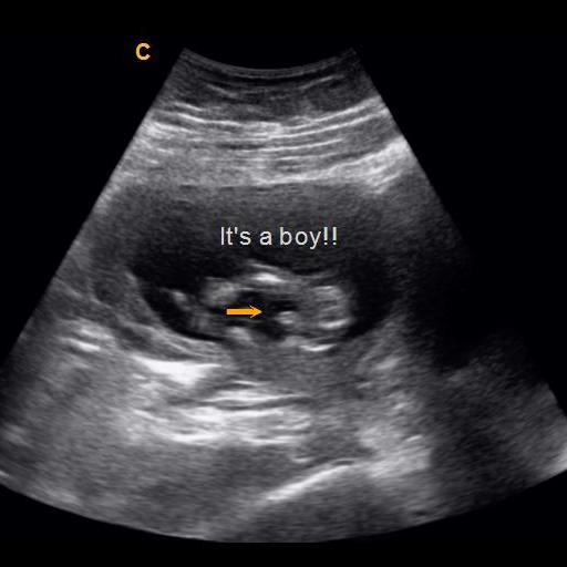 Its A Boy Ultrasound 14 Weeks