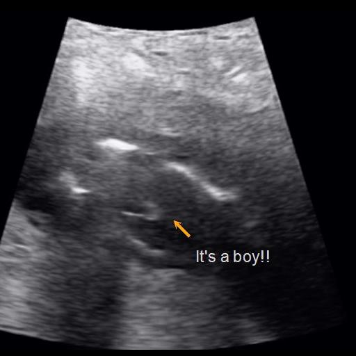 Early Gender Boys 15 Weeks | 3D 4D 5D HD Ultrasound Michigan