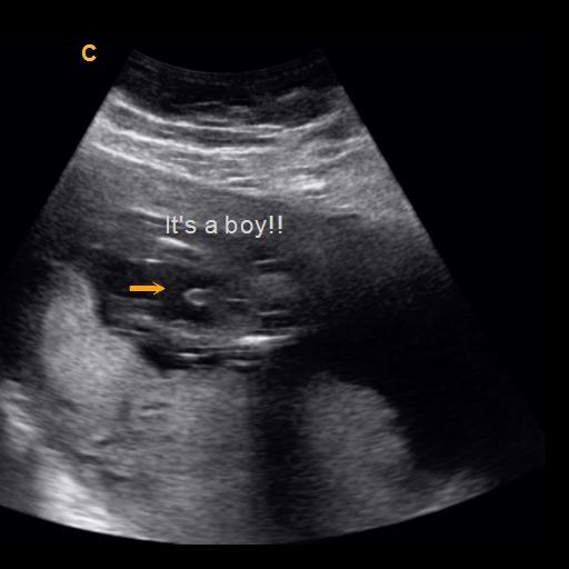 Early Gender Boys 15 Weeks | 3D 4D 5D HD Ultrasound Michigan