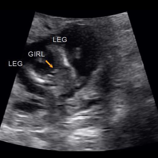 Early Gender Girls 15 Weeks | 3D 4D 5D HD Ultrasound Michigan
