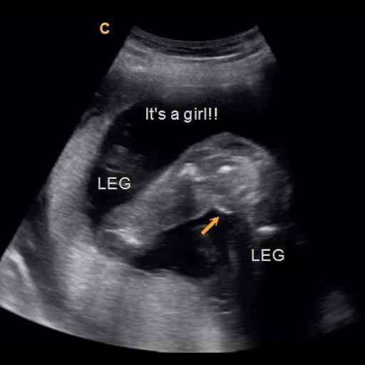 Early Gender Girls 15 Weeks 3D 4D 5D HD Ultrasound Michigan