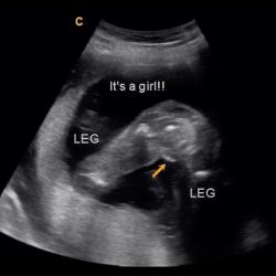Early Gender Determination 14 Weeks 3D 4D 5D Ultrasound. 